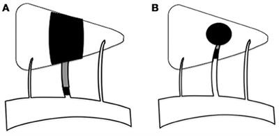 Different Mechanisms of Two Subtypes of Perforating Artery Infarct in the Middle Cerebral Artery Territory: A High-Resolution Magnetic Resonance Imaging Study